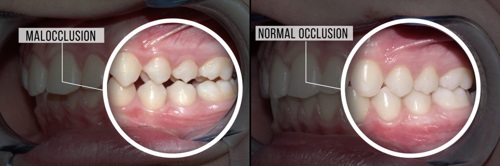 occlusal-adjustment-matthews-nc-fix-bite-misalignment